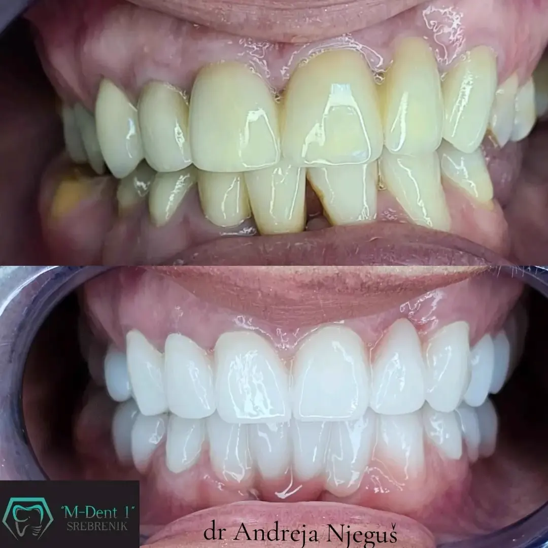 M-Dent 1 Srebrenik
